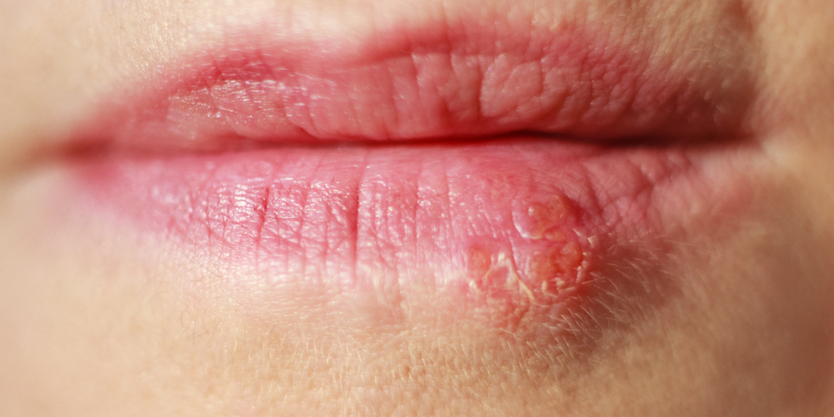 How To Help Prevent Cold Sores? — Here's Health